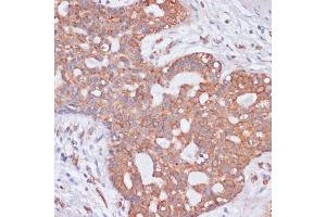 Immunohistochemistry of paraffin-embedded human breast cancer using KCNH2 antibody (ABIN3023435, ABIN3023436, ABIN3023437 and ABIN6219948) at dilution of 1:100 (40x lens). (KCNH2 antibody)
