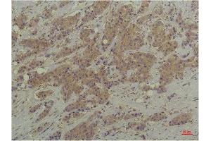 Immunohistochemistry (IHC) analysis of paraffin-embedded Human Breast Carcinoma using P44/42 MAPK (ERK1/2) Mouse Monoclonal Antibody diluted at 1:200. (ERK1/2 antibody)