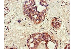 Immunohistochemistry of paraffin-embedded human breast cancer using ABIN7170364 at dilution of 1:100 (SNX17 antibody  (AA 280-457))