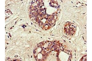 Immunohistochemistry of paraffin-embedded human breast cancer using ABIN7170364 at dilution of 1:100
