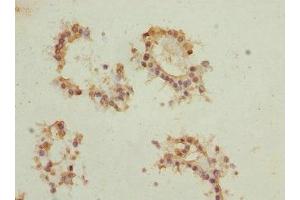 Immunohistochemistry of paraffin-embedded human breast cancer using ABIN7172902 at dilution of 1:100 (EIF2B1 antibody  (AA 1-305))