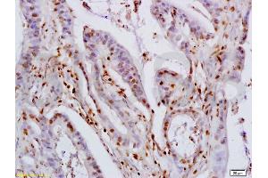 Formalin-fixed and paraffin embedded human colon carcinoma labeled with Rabbit Anti KLF4 Polyclonal Antibody, Unconjugated (ABIN737121) at 1:200 followed by conjugation to the secondary antibody and DAB staining (KLF2/4 antibody  (AA 415-513))
