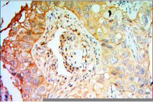 Immunohistochemical analysis of paraffin-embedded lung cancer tissues using PTK7 mouse mAb with DAB staining. (PTK7 antibody)