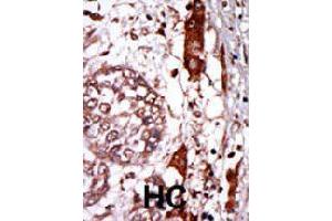 Formalin-fixed and paraffin-embedded human hepatocellular carcinoma tissue reacted with GNB2L1 polyclonal antibody  , which was peroxidase-conjugated to the secondary antibody, followed by AEC staining. (CDR2 antibody  (N-Term))