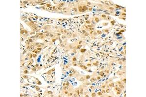 Immunohistochemistry of paraffin embedded human gastric cancer using MST1 (ABIN7075561) at dilution of 1: 1000 (400x lens) (STK4 antibody)