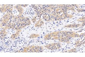 Detection of MAPK14 in Human Lung cancer Tissue using Polyclonal Antibody to Mitogen Activated Protein Kinase 14 (MAPK14) (MAPK14 antibody  (AA 19-279))