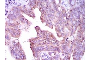 Immunohistochemical analysis of paraffin-embedded rectum cancer tissues using CAMK4 mouse mAb with DAB staining. (CAMK4 antibody  (AA 35-292))