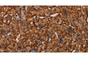 Immunohistochemistry of paraffin-embedded Human prostate cancer tissue using COL18A1 Polyclonal Antibody at dilution 1:40 (COL18A1 antibody)