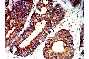 Immunohistochemical analysis of paraffin-embedded rectum cancer tissues using BAK1 mouse mAb with DAB staining.