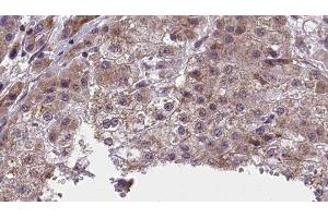 ABIN6277415 at 1/100 staining Human liver cancer tissue by IHC-P. (NFASC antibody  (C-Term))