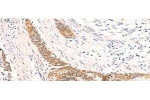 Immunohistochemistry of paraffin-embedded Human esophagus cancer tissue using HSPA4L Polyclonal Antibody at dilution of 1:30(x200) (HSPA4L antibody)