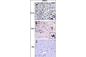 IHC of matched glioma core (top row) and rim (middle row) samples as well as normal brain control (bottom row) from a glioma invasion specific tissue microarray. (MAP2K3 antibody  (N-Term))