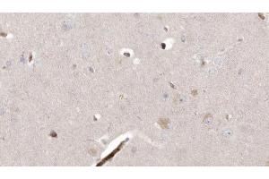 ABIN6273003 at 1/100 staining Human brain cancer tissue by IHC-P. (L2HGDH antibody  (Internal Region))