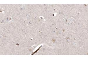 ABIN6273003 at 1/100 staining Human brain cancer tissue by IHC-P.