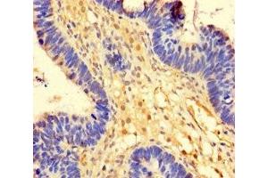 Immunohistochemistry of paraffin-embedded human ovarian cancer using ABIN7174393 at dilution of 1:100 (OTUB1 antibody  (AA 2-201))