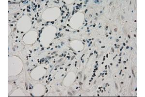 Immunohistochemical staining of paraffin-embedded Adenocarcinoma of colon tissue using anti-PPP1R7mouse monoclonal antibody. (PPP1R7 antibody)