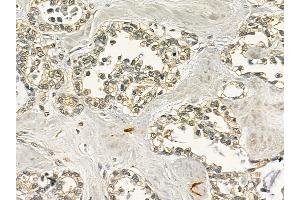 ZFP91 Mouse Monoclonal Antibody at 1/100 staining human ovarian cancer by IHC-P.