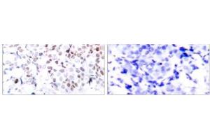Immunohistochemical analysis of paraffin-embedded human breast carcinoma tissue using Myc (phospho- Thr358) antibody (E011035). (c-MYC antibody  (pThr358))