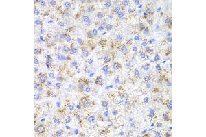 Immunohistochemistry of paraffin-embedded human liver cancer using HAO1 antibody (ABIN5973868) at dilution of 1/200 (40x lens). (HAO1 antibody)