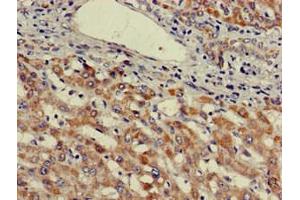 Immunohistochemistry of paraffin-embedded human liver cancer using ABIN7174571 at dilution of 1:100 (ube3a antibody  (AA 83-234))