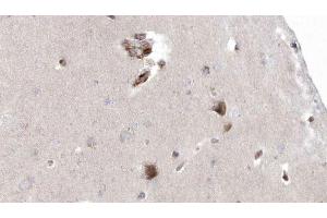ABIN6272926 at 1/100 staining Human brain cancer tissue by IHC-P. (OXCT1 antibody  (Internal Region))