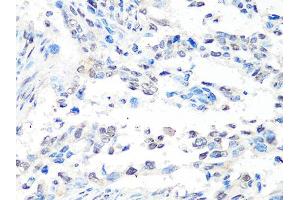 Immunohistochemistry of paraffin-embedded human lung cancer using MTA2 Antibody (ABIN5998268) at dilution of 1/100 (40x lens). (MTA2 antibody)