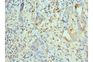 Immunohistochemistry of paraffin-embedded human lung cancer using ABIN7157649 at dilution of 1:100