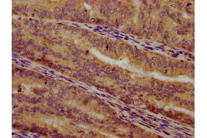 IHC image of ABIN7150582 diluted at 1:300 and staining in paraffin-embedded human endometrial cancer performed on a Leica BondTM system. (ALG1 antibody  (AA 197-249))