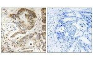 Immunohistochemistry analysis of paraffin-embedded human colon carcinoma tissue using PIK3R5 antibody. (PIK3R5 antibody)