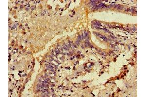 Immunohistochemistry of paraffin-embedded human lung cancer using ABIN7146326 at dilution of 1:100 (EFHA1 antibody  (AA 26-247))