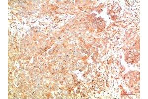Immunohistochemical analysis of paraffin-embedded Human Breast Carcinoma Tissue using ATG7 Mouse mAb diluted at 1:200. (ATG7 antibody)