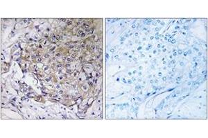 Immunohistochemistry analysis of paraffin-embedded human breast carcinoma tissue, using WASF3 Antibody. (WASF3 antibody  (AA 151-200))