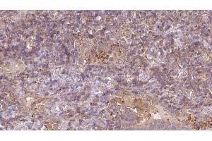 ABIN6273054 at 1/100 staining Human lymph cancer tissue by IHC-P. (MAT1A antibody  (N-Term))