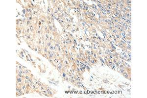 Immunohistochemistry of Human lung cancer using SLC27A1 Polyclonal Antibody at dilution of 1:40 (SLC27A1 antibody)