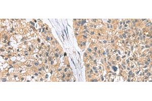 Immunohistochemistry of paraffin-embedded Human esophagus cancer tissue using RGS2 Polyclonal Antibody at dilution of 1:95(x200) (RGS2 antibody)