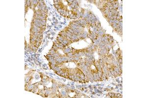 Immunohistochemistry of paraffin-embedded human colon carcinoma using GM130 antibody (ABIN6129789, ABIN6141264, ABIN6141265 and ABIN6220979) at dilution of 1:25 (40x lens). (Golgin A2 (GOLGA2) (AA 20-300) antibody)