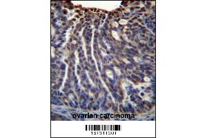 HOXB3 Antibody immunohistochemistry analysis in formalin fixed and paraffin embedded human ovarian carcinoma followed by peroxidase conjugation of the secondary antibody and DAB staining. (HOXB3 antibody  (AA 119-148))