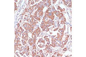 Immunohistochemistry of paraffin-embedded human liver cancer using LRP1 antibody (ABIN3021968, ABIN3021969, ABIN3021970 and ABIN6218530) at dilution of 1:100 (40x lens).