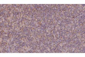 ABIN6273131 at 1/100 staining Human lymph cancer tissue by IHC-P. (KIFC3 antibody  (C-Term))