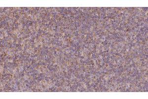 ABIN6273131 at 1/100 staining Human lymph cancer tissue by IHC-P. (KIFC3 antibody  (C-Term))