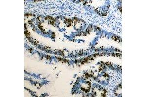 Immunohistochemical analysis of RB1 (pS795) staining in human colon cancer formalin fixed paraffin embedded tissue section. (Retinoblastoma 1 antibody  (C-Term, pSer795))
