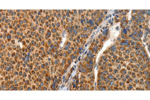 Immunohistochemistry of paraffin-embedded Human liver cancer tissue using ANGPTL1 Polyclonal Antibody at dilution 1:40