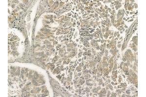 ABIN6263303 and ABIN6273267 at 1/100 staining human lung squamous cell carcinoma by IHC-P. (MMP28 antibody  (Internal Region))