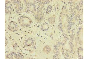Immunohistochemistry of paraffin-embedded human breast cancer using ABIN7172114 at dilution of 1:100 (TK1 antibody  (AA 2-234))