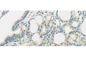 Immunohistochemistry of paraffin-embedded Human thyroid cancer using SLC7A11 Polyclonal Antibody at dilution of 1/35