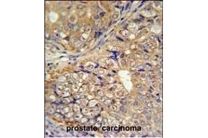 KLHL9 Antibody (Center) (ABIN651366 and ABIN2840204) IHC analysis in formalin fixed and paraffin embedded human prostate carcinoma followed by peroxidase conjugation of the secondary antibody and DAB staining. (KLHL9 antibody  (AA 299-326))