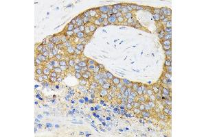 Immunohistochemistry of paraffin-embedded human esophageal cancer using RPS3 Rabbit pAb (ABIN3023342, ABIN3023343, ABIN3023344 and ABIN6219623) at dilution of 1:100 (40x lens). (RPS3 antibody  (AA 1-243))