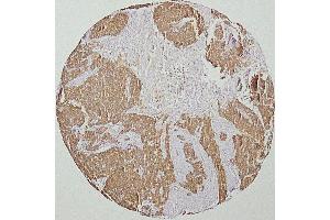 human head and neck squamous-cell carcinoma (HNSCC)(courtesy of J. (Cytokeratin 19 antibody)