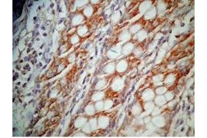 Human colon cancer tissue was stained by Rabbit Anti-GLP-1 (12-24) (Human) Antibody (GLP-1 antibody  (AA 12-24))