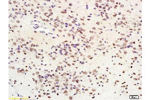Formalin-fixed and paraffin embedded human glioma tissue labeled with Anti-SIRT1 Polyclonal Antibody, Unconjugated (ABIN679028) at 1:200 followed by conjugation to the secondary antibody and DAB staining (SIRT1 antibody  (AA 551-650))